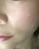 毛穴洗浄（ハイドラフェイシャルなど） / ルメッカ ON-CLINIC Beauty BEFORE サムネイル用