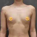豊胸（脂肪注入） / 脂肪注入（肌） / 乳頭縮小 ヴェルトラクリニック 大阪院 BEFORE サムネイル用