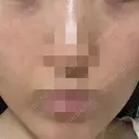 ニードルRF（ポテンツァなど） ながしま形成外科クリニック BEFORE サムネイル用