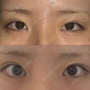 目頭切開 / タレ目形成・グラマラスライン（埋没） ネビュラクリニック 東京錦糸町院 BEFORE サムネイル用