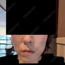 ハイフ（顔） / 毛穴洗浄（ハイドラフェイシャルなど） S-Laboクリニック 渋谷院 BEFORE サムネイル用