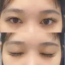 二重埋没 / RF（高周波）たるみ治療 Wing clinic 豊中駅前院 BEFORE サムネイル用