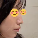 鼻尖形成（切開） / ワシ鼻修正・ハンプ切除 / 眉間プロテーゼ / 鼻柱下降・鼻唇角形成（猫手術） / ヒアルロン酸注入（額） グローバルビューティークリニック 大阪院 BEFORE サムネイル用