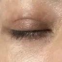 その他（目元） TCB東京中央美容外科 梅田茶屋町院 BEFORE サムネイル用