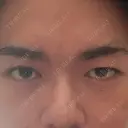 眼瞼下垂（切開） / 上まぶたの脂肪取り 新前橋かしま眼科形成外科クリニック BEFORE サムネイル用