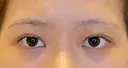 目尻切開 / タレ目形成・グラマラスライン（埋没） LOUIS CLINIC 二子玉川院【ルイクリニック】 BEFORE サムネイル用