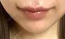 ヒアルロン酸注入（唇） / ボトックス（口角） BITO BEAUTY CLINIC BEFORE サムネイル用