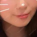 ヒアルロン酸注入（唇） / ボトックス（口角） / RF（高周波）たるみ治療 ルラ美容クリニック 京都院 BEFORE サムネイル用