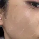 ピコスポット ビューティー和心クリニック 浅草院 BEFORE サムネイル用