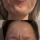 ボトックス（あご） / ボトックス（眉間） / ボトックス（額） TCB東京中央美容外科 名古屋栄院 BEFORE サムネイル用