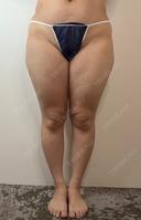 脂肪吸引（顔） / 脂肪吸引（脚） / 脂肪吸引（お尻） GAYA body design clinic BEFORE サムネイル用