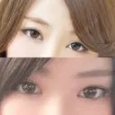 二重埋没 品川美容外科 仙台院 BEFORE サムネイル用