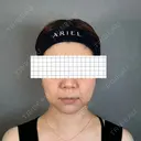 バッカルファット除去 アリエル美容クリニック 大宮院 BEFORE サムネイル用