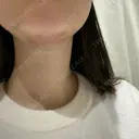 糸リフト / 脂肪吸引（顔） Wing clinic 豊中駅前院 BEFORE サムネイル用