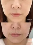 脂肪溶解注射（顔） / ボトックス（口角） / ボトックス（眉間） / ボトックス（額） / その他（肌） ルラ美容クリニック 仙台院 / ルラスキンクリニック 仙台院 BEFORE サムネイル用