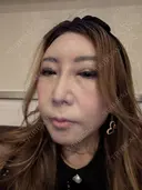 人中短縮 / ボトックス（人中） アネシス美容クリニック BEFORE サムネイル用