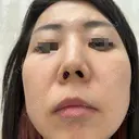 ボトックス（額） / その他（肌） 大美会クリニック 京都烏丸院 BEFORE サムネイル用