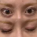 二重埋没 サラ美容外科 BEFORE サムネイル用