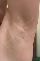 ワキ汗治療（切開） 石倉クリニック 水戸院 BEFORE サムネイル用