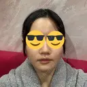 鼻尖形成（切開） / 小鼻縮小（切開） / 軟骨移植 / 鼻柱下降・鼻唇角形成（猫手術） / ボトックス（エラ・小顔） ASTRA BEAUTY CLINIC BEFORE サムネイル用