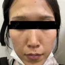 毛穴洗浄（ハイドラフェイシャルなど） / ピコレーザートーニング（美白・肝斑） CIEL SKIN CLINIC（シエルスキンクリニック） BEFORE サムネイル用