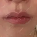 ヒアルロン酸注入（唇） AZ BEAUTY CLINIC BEFORE サムネイル用