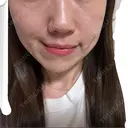 RF（高周波）たるみ治療 ルラ美容クリニック 福岡本院 BEFORE サムネイル用