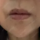 肌ヒアルロン酸注入（たるみ・シワ改善） / ピコレーザートーニング（美白・肝斑） 渋谷美容外科クリニック 横浜院 BEFORE サムネイル用