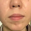 ボトックス（あご） / ボトックス（目尻） / ボトックス（額） 代々木駅前美容クリニック BEFORE サムネイル用