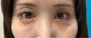 脂肪注入（目の下） アネシス美容クリニック BEFORE サムネイル用