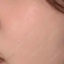 ルメッカ ON-CLINIC Beauty BEFORE サムネイル用