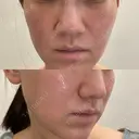 毛穴洗浄（ハイドラフェイシャルなど） / ポテンツァ ルラ美容クリニック 京都院 BEFORE サムネイル用