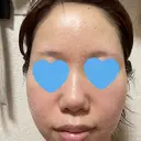 ボトックス（エラ・小顔） / ヒアルロン酸注入（鼻翼基部） 目白ホワイトクリニック BEFORE サムネイル用