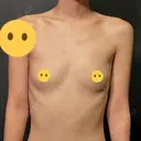 豊胸（シリコンバッグ） / 豊胸（脂肪注入） / 乳頭縮小 / 豊胸（シリコン＋脂肪併用） MYCLI【マイクリ】東京・恵比寿院 BEFORE サムネイル用