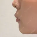 ヒアルロン酸注入（あご） 青山外苑前クリニック BEFORE サムネイル用