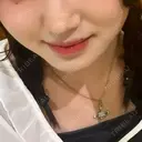 ヒアルロン酸注入（鼻翼基部） ジョウクリニック 大阪院 BEFORE サムネイル用