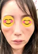 ヒアルロン酸注入（頬） 百人町アルファクリニック BEFORE サムネイル用