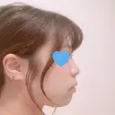 鼻中隔延長（切開） / 軟骨移植 / 鼻尖縮小 HANABI整形外科 BEFORE サムネイル用