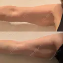 脂肪溶解注射（二の腕） FIG CLINIC BEFORE サムネイル用
