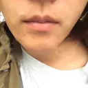 脂肪溶解注射（顔） あらなみクリニック 千葉院 BEFORE サムネイル用