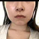 エレクトロポレーション / 光治療（フォトフェイシャルなど） / ピーリング（ハリ・ツヤ） トラスト美容クリニック 銀座院 BEFORE サムネイル用