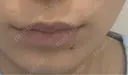 ボトックス（口角） mimi CLINIC BEFORE サムネイル用