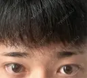 眉下切開 表参道ウィズ・クリニック BEFORE サムネイル用