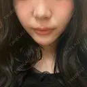 ヒアルロン酸注入（涙袋） / 肌ヒアルロン酸注入（たるみ・シワ改善） / ヒアルロン酸注入（唇） / ボトックス（口角） 東京シルククリニック 新宿院 BEFORE サムネイル用