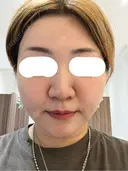 ボトックス（あご） / ボトックス（口角） / ボトックス（額） 東京美容医療クリニック 池袋院 BEFORE サムネイル用