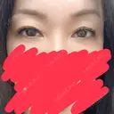 ヒアルロン酸注入（涙袋） AZ BEAUTY CLINIC BEFORE サムネイル用