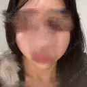 糸リフト / バッカルファット除去 / 脂肪吸引（顔） / ジョールファット除去 / ボトックス（エラ・小顔） アリエル美容クリニック 横浜院 BEFORE サムネイル用