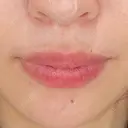 ヒアルロン酸注入（唇） / ヒアルロン酸注入（鼻翼基部） HAAB×DREAM BEAUTY CLINIC 大阪梅田院 BEFORE サムネイル用