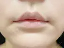 ヒアルロン酸注入（唇） 目白ホワイトクリニック BEFORE サムネイル用