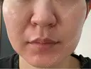 ピコレーザートーニング（美白・肝斑） / フラクショナルレーザー（毛穴・ニキビ跡） ルラ美容クリニック 横浜院 BEFORE サムネイル用